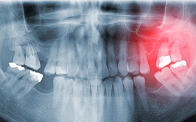 ParadontoScreen – diagnostic de gingivite și parodontite